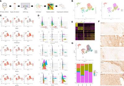 Single-cell RNA-seq analysis reveals that immune cells induce human nucleus pulposus ossification and degeneration